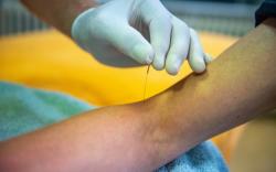 Juli - Dryneedling 